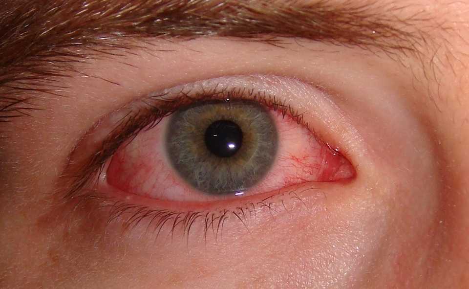 What Is Pink Eye (or Conjunctivitis)?