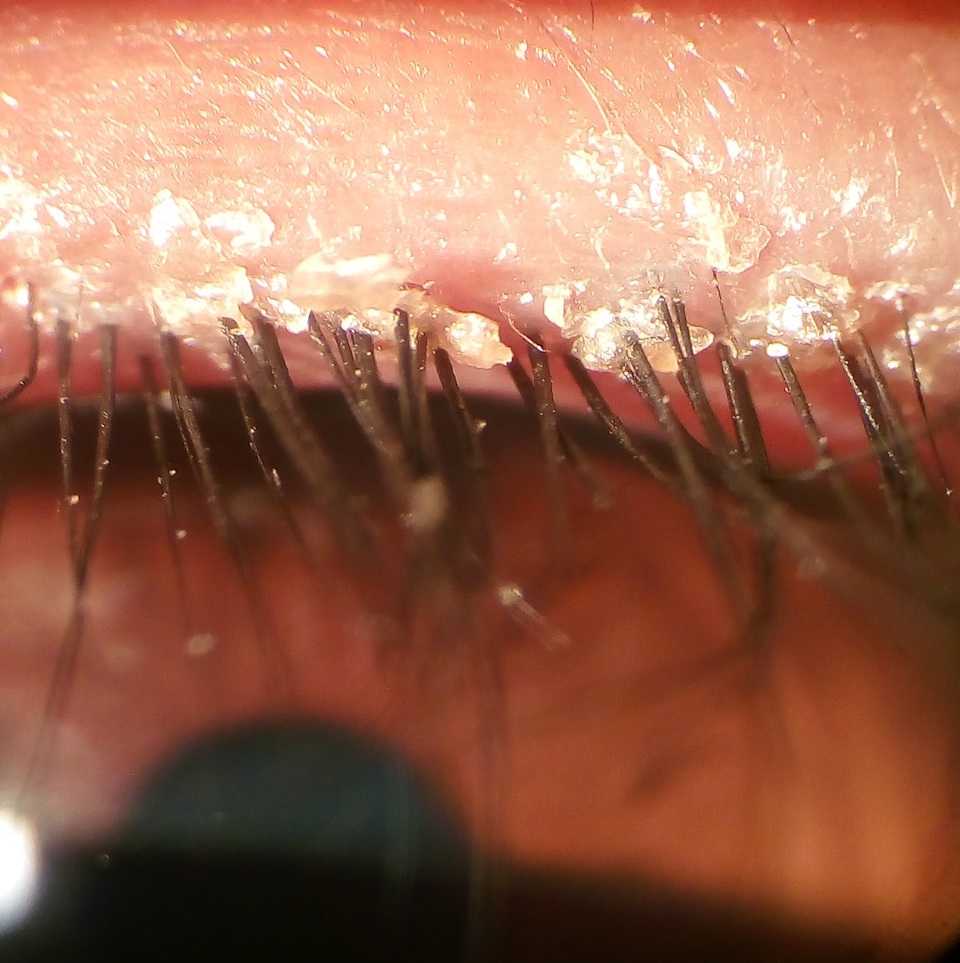 What Is Blepharitis