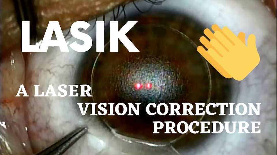 Performing a Lasik Correction