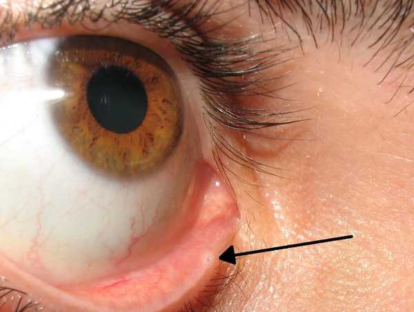 Lacrimal Punctum, image by <a href="https://commons.wikimedia.org/wiki/File:Lacrimal_punctum.jpg" title="via Wikimedia Commons">Diogo Melo Rocha (dmelorj)</a> / <a href="https://creativecommons.org/licenses/by/2.5">CC BY</a>