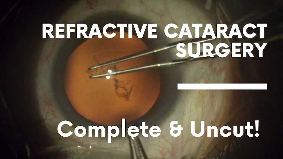 Complete Refractive Cataract Surgery